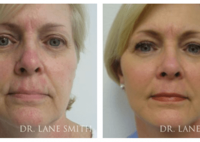 Dr lane smith before and after photo.