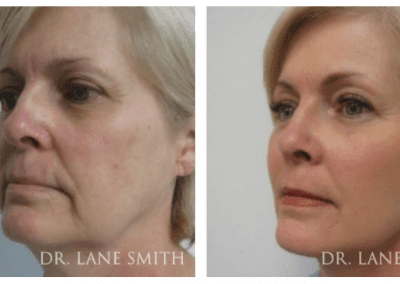 Dr lane smith before and after photo.