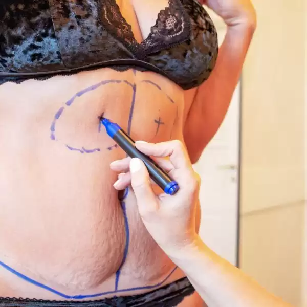 A woman undergoes liposuction and then draws on her stomach with a marker.