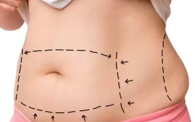 Pregnancy After Tummy Tuck Surgery What Happens