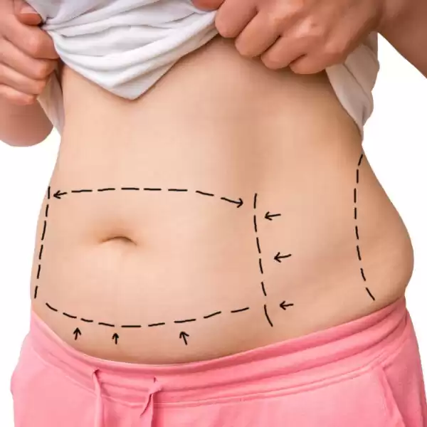 Pregnancy After Tummy Tuck Surgery What Happens