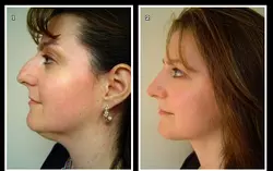 A woman's face before and after potential liposuction.