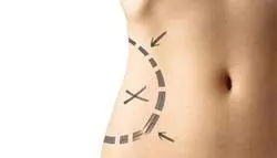An advanced body shaping technology, VASERLIPO®, sculpts a woman's stomach with precise arrows pointing in different directions.