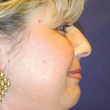 Buccal Fat Pad Removal 1 Buccal Fat Pad Removal