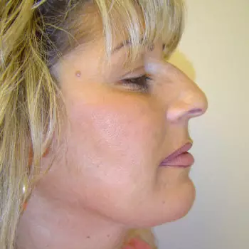 Buccal Fat Pad Removal 2 Buccal Fat Pad Removal