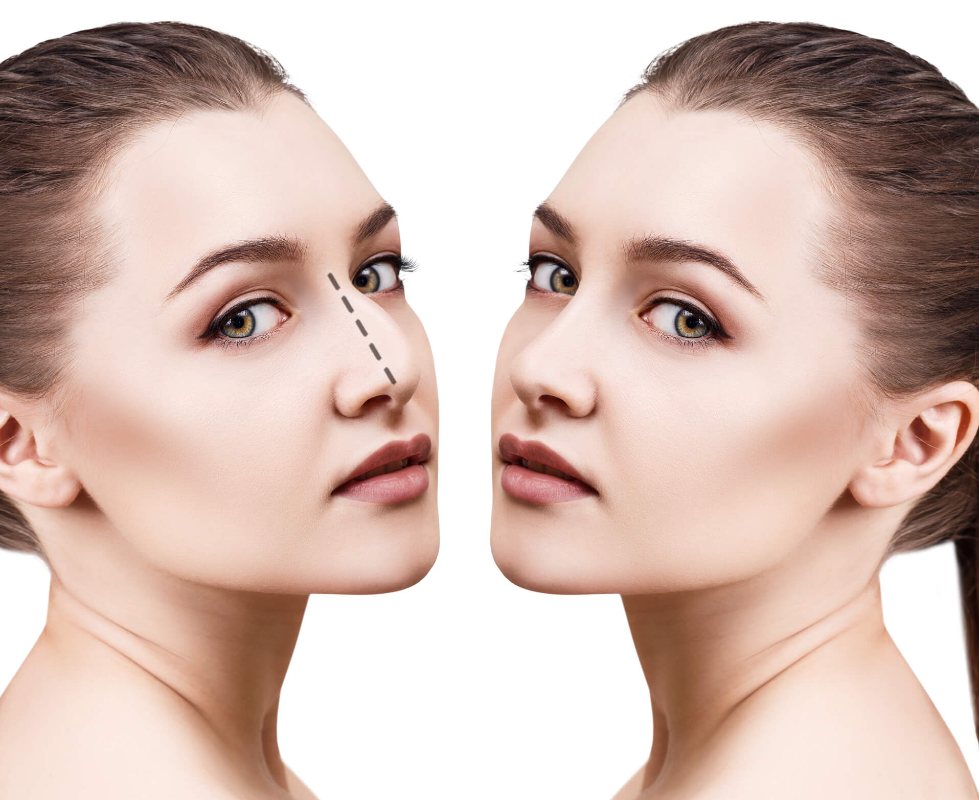 Las Vegas Rhinoplasty Las Vegas Rhinoplasty