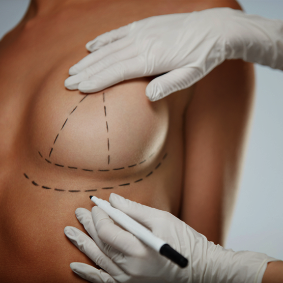 A woman is having surgery on her breast. A woman is having surgery on her breast.