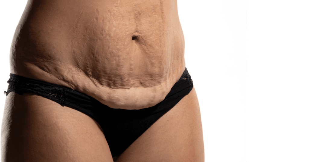 Mommy Makeover Surgery in Las Vegas: Is It Right for You? 1 A close-up of a person’s lower abdomen showing loose skin and stretch marks, wearing black underwear, against a white background—a common concern addressed with Mommy Makeover Surgery in Las Vegas.