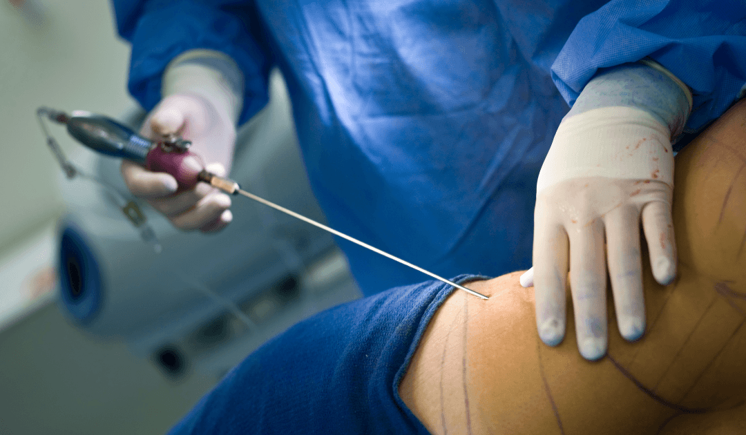 Liposuction in Las Vegas procedure for body contouring and targeted fat removal at Smith Plastic Surgery