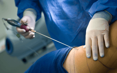 Liposuction in Las Vegas : What Areas Can Be Treated Most Effectively?