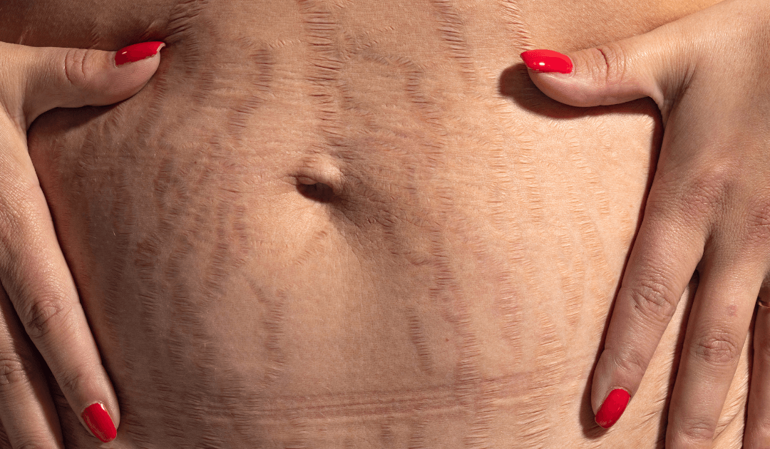 Mommy Makeover in Las Vegas : What Procedures Are Commonly Included?