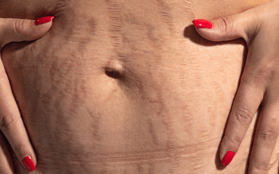 Blog 1 Mommy Makeover in Las Vegas : What Procedures Are Commonly Included?