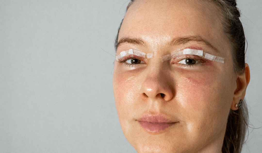 Eyelid Lift Cosmetic Surgery: How Blepharoplasty Can Refresh Your Appearance