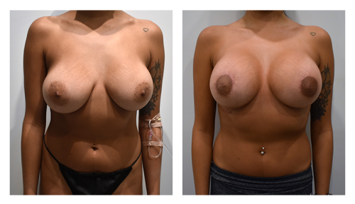 Breast Lift Gallery