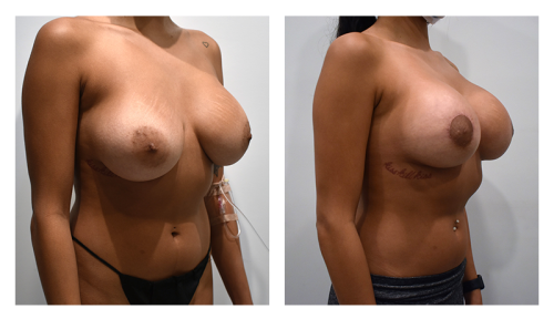 Corrective Breast Surgery Gallery