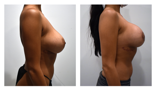 Corrective Breast Surgery Gallery