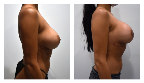 Breast Lift Gallery