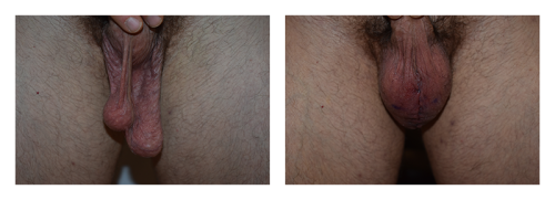 Scrotoplasty Before and After Gallery