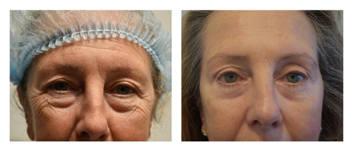 Brow Lift Gallery