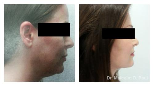 Pre and post op face and necklift, and temporal brow lift