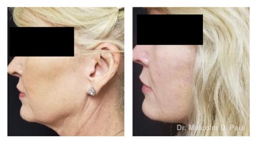 Pre and post op face and necklift