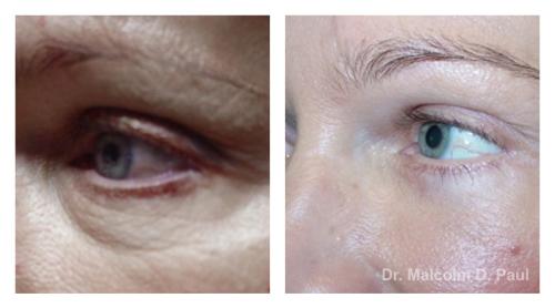 Pre and post op upper and lower lid blepharoplasties, and browpexy