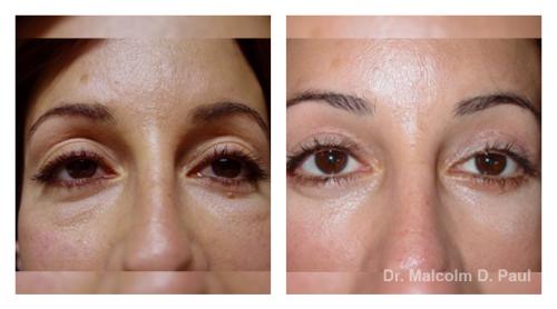 Pre and post op secondary lower lid blepharoplasties