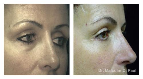 Pre and post op upper and lower lid blepharoplasties