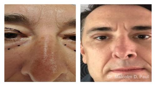 Pre and post op upper and lower lid blepharoplasties