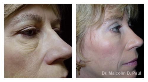 Pre and post op upper and lower lid blepharoplasties