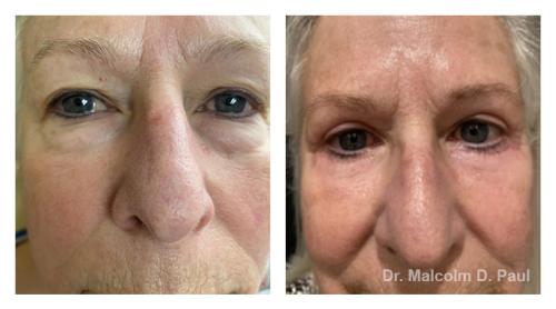 Pre and post op upper and lower lid blepharoplasties