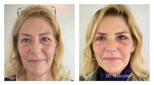 Pre and post op upper and lower lid blepharoplasties