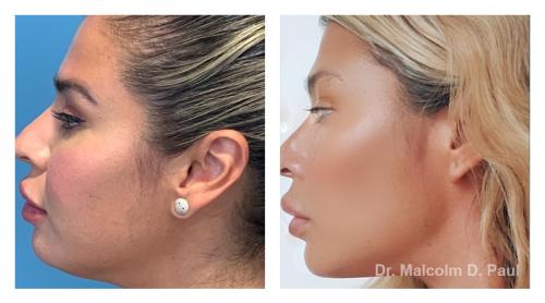 Pre and post op buccal fat pad removal and jawline liposuction