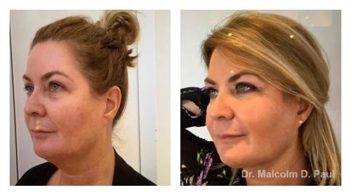 Pre and post op buccal fat pad removal and jawline liposuction