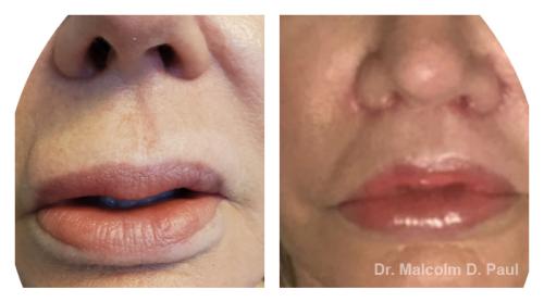 Pre and post op upper lip lift