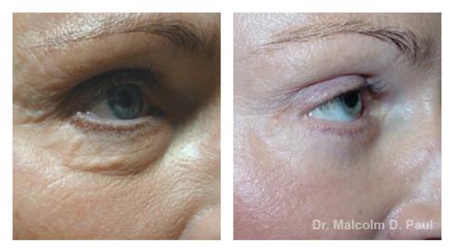 Pre and post op upper and lower lid blepharoplasties, and browpexy