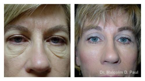 Pre and post op upper and lower lid blepharoplasties