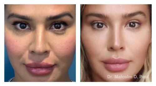 Pre and post op buccal fat pad removal and jawline liposuction