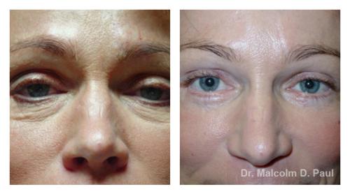 Pre and post op upper and lower lid blepharoplasties, and browpexy