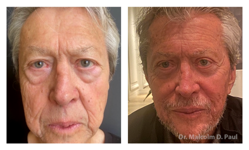 Pre and post op blepharoplasties, face and neck lift, and direct excision of naso-labia folds