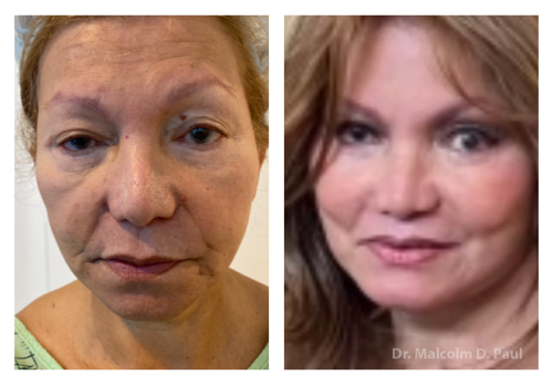 Blepharoplasties, face and necklift