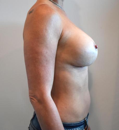 Corrective Breast Surgery Gallery