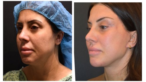 BeforeAfter-1423  34