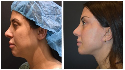 BeforeAfter-1423 Right