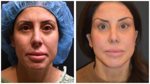 BeforeAfter-1423 Center