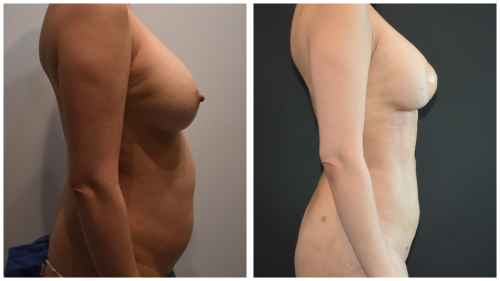 BeforeAfter-1430 Right