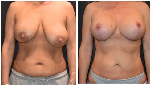 BeforeAfter-b1424 Center