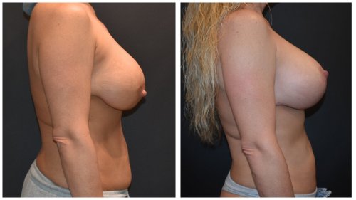 BeforeAfter-b1424 Right