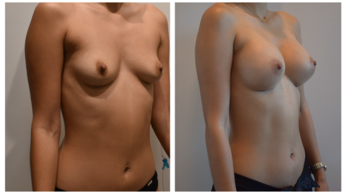 BeforeAfter-b1428 