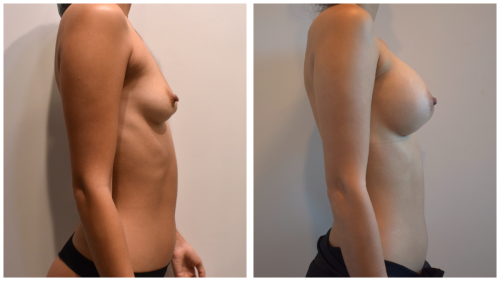 BeforeAfter-b1428 
